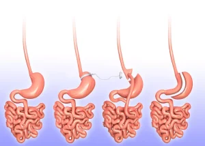 Gastric Sleeve