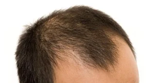 hair loss