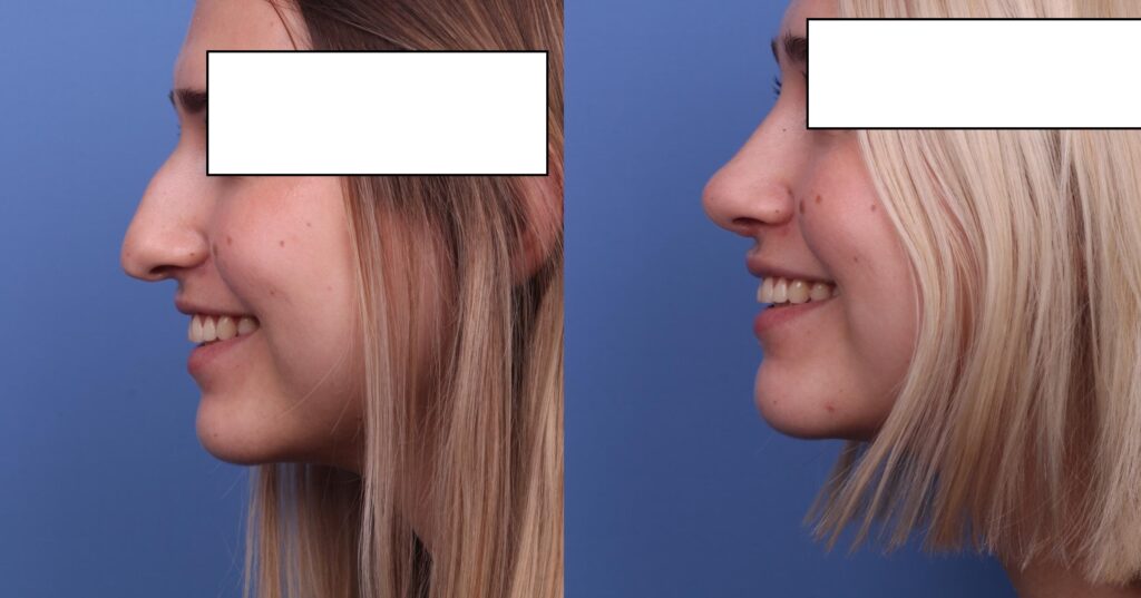 Rhinoplasty in London