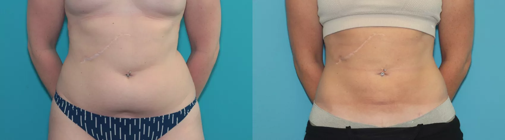 Liposuction in Dubai