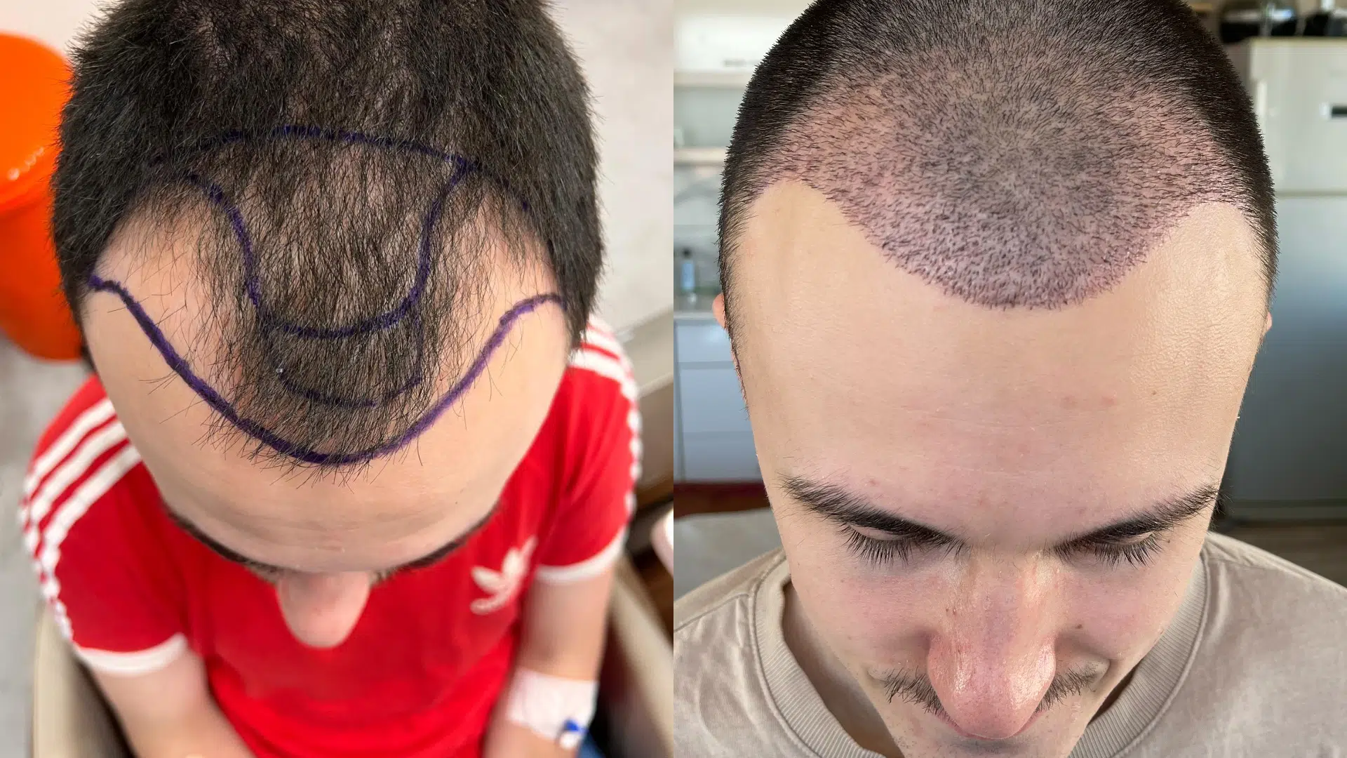 Hair Transplant